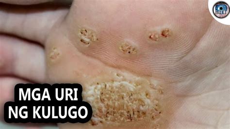 uri ng kulugo|Tips para mawala ang kulugo .